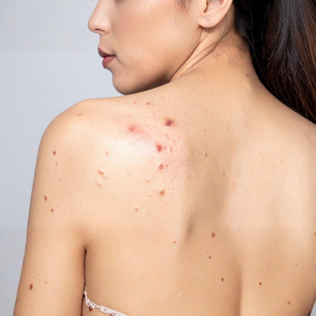 Back Acne